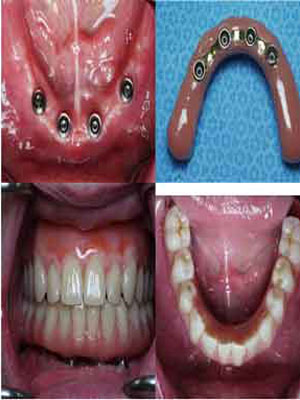 Best dental implants treatment in ashok vihar, delhi