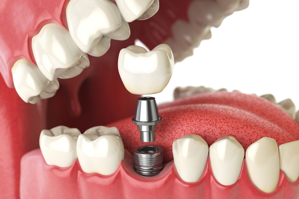 best dental implants centre in vikaspuri