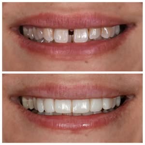 Gap closure treatment in vaishali, Ghaziabad