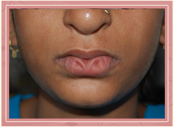 Cleft of the lower lip Pre Operative