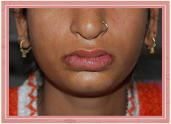 Cleft of the lower lip Post Operative