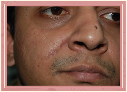 Excision of Moles Post Operative