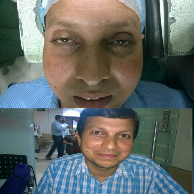 Ptosis Droopling Eyelid Pre and Post Operative
