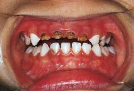 Front teeth cavities in children