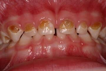 Front teeth of children