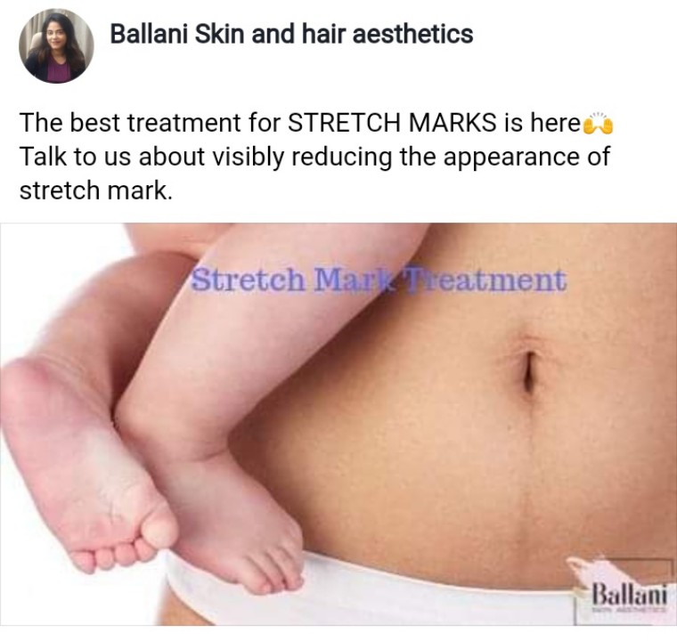 Stretch Mark Removal at Ballani Skin And Hair Aesthetics
