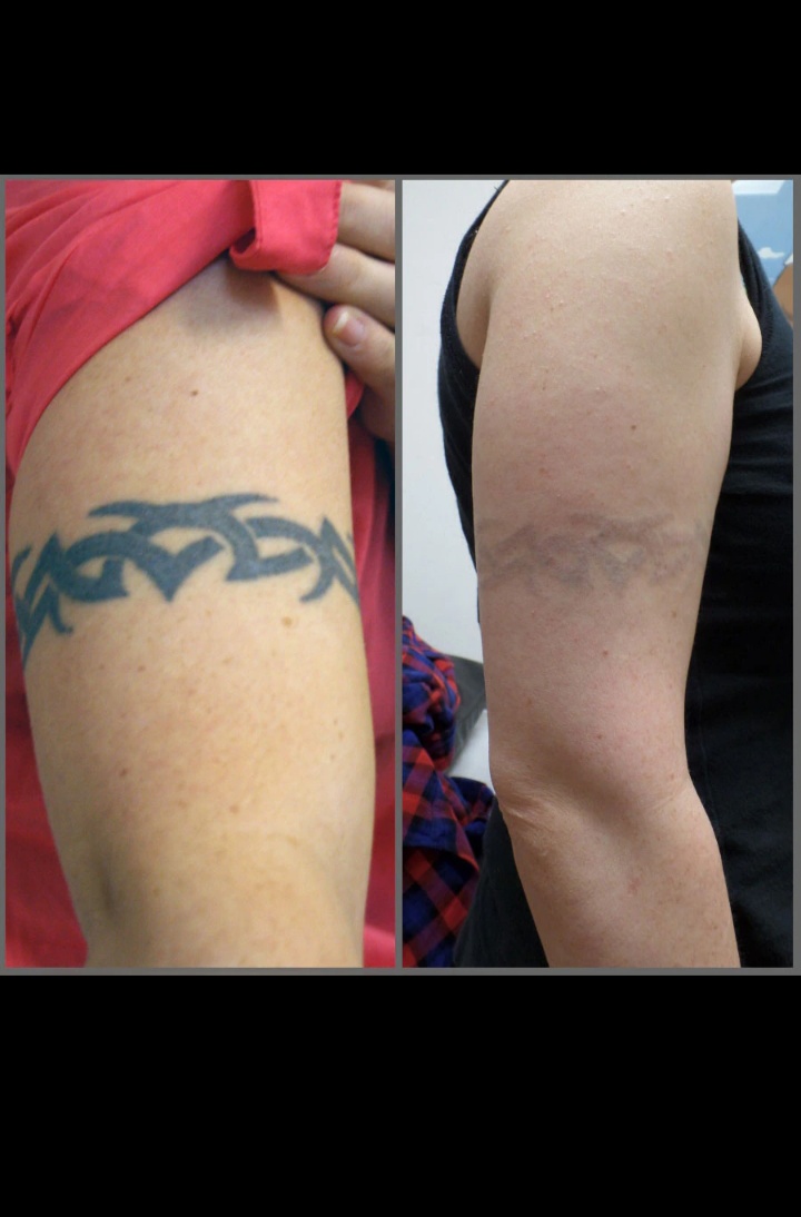 Tattoo Removal at Soumya Skin & Cosmetic Clinic Rajouri Garden