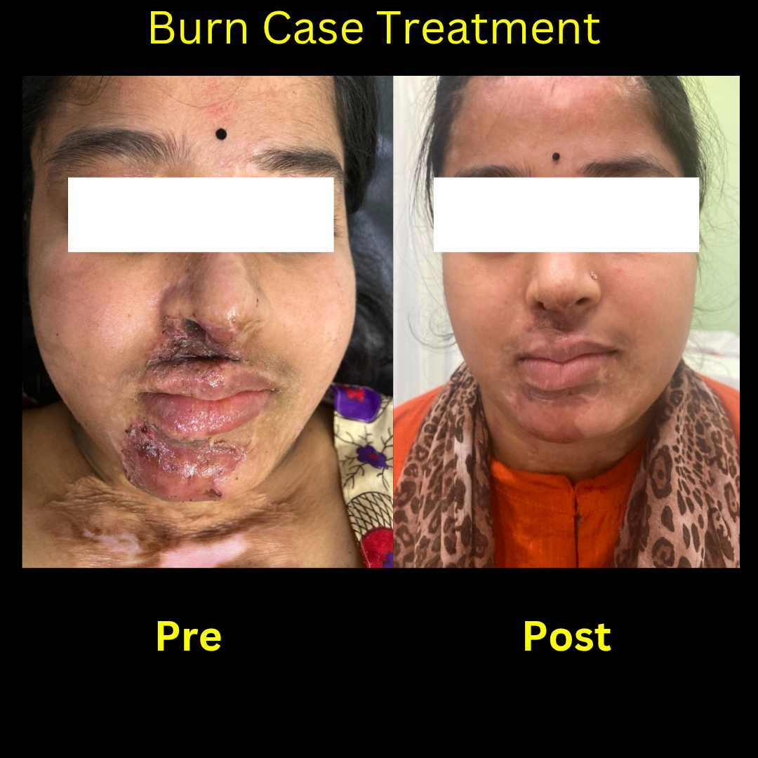 Burn Case Treatment