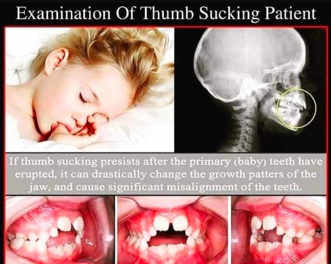 Examination of thumb sucking in kids, Indirapuram