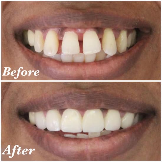 Before & After