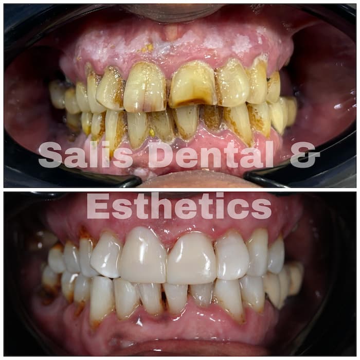 Teeth cleaning, teeth whitening and Veneers done in 24 hours time in Sector 74, Noida