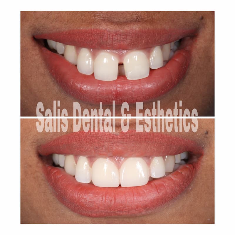 Diastema, Front Teeth Gap Closure with Veneers